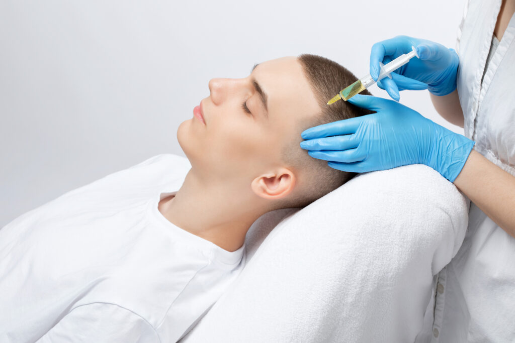 Séance de mésothérapie capillaire pour la chute de cheveux, avec injection superficielle d’un complexe nutritif dans le cuir chevelu.